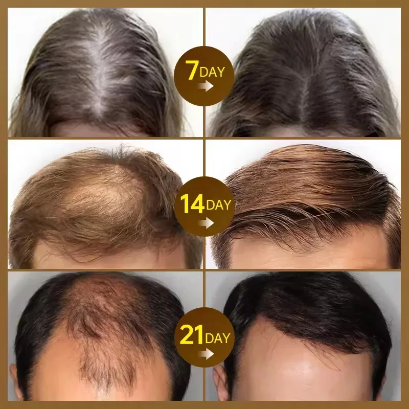 

Hair Growth Serum 7 Days Fast Regrowth Essential Capsule Anti Hair loss Baldness Repair Damaged Scalp Treatment For Women Men