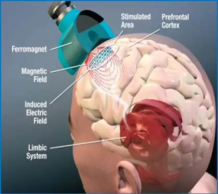 Super Rtms Rtmsfast Delivery Portable Rtms Therapy Device Brain Rtms Transcranial Magnetic Stimulator