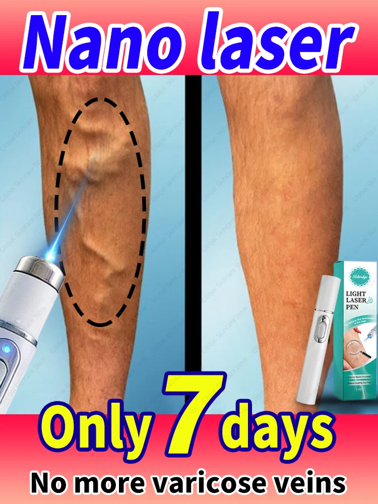 

Laser highly effective in repairing leg veins