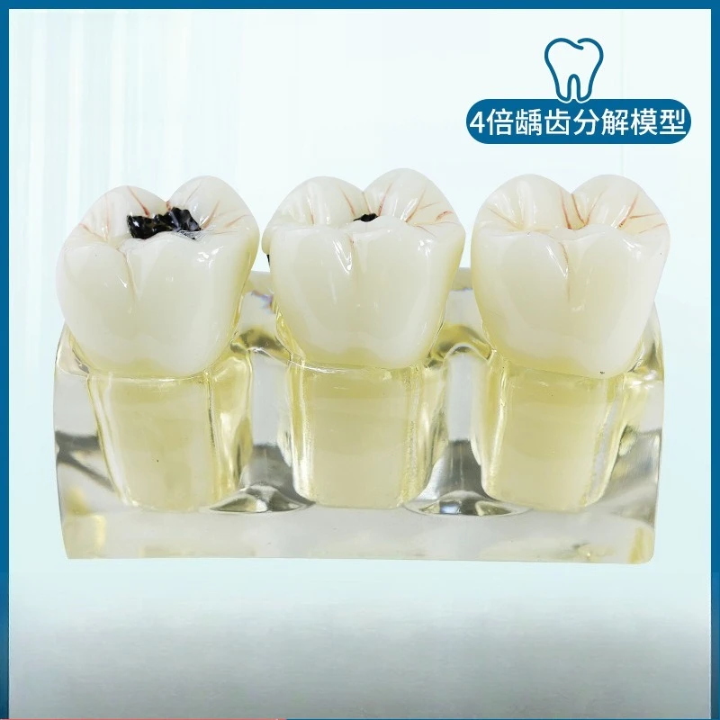 Transparent 4x caries decomposition model detachable dental nerve denture model caries simulation