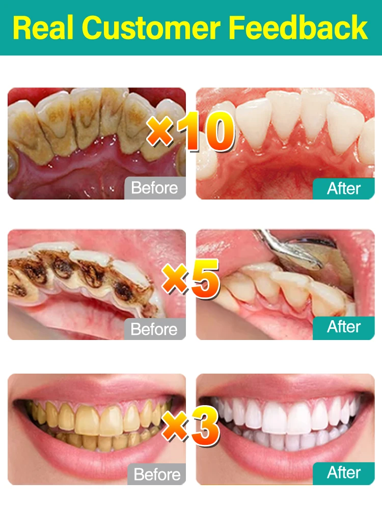 Removedor de cálculo dental, clareamento dos dentes, remoção de odor da boca, mau hálito, prevenção da periodontite