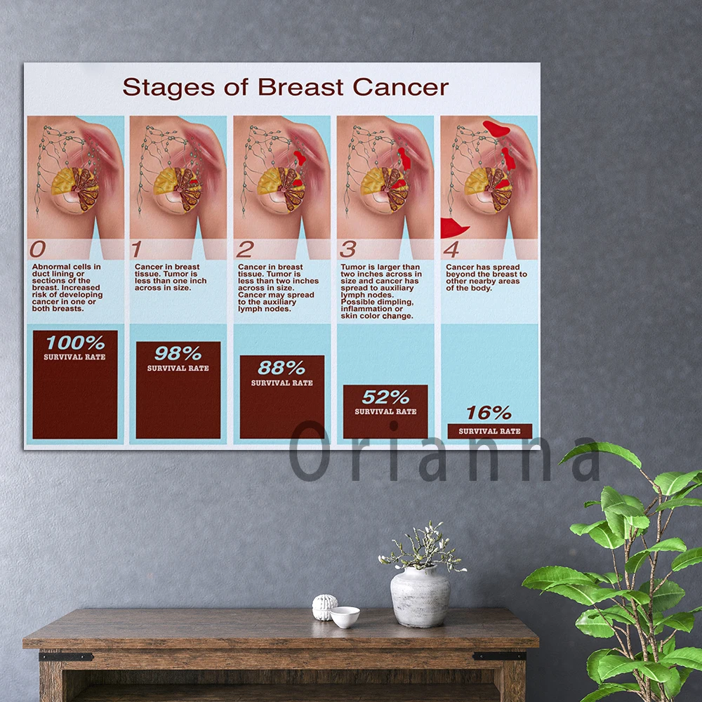 Home Decor Print Stages Of Breast Cancer Horizontal Canvas Painting Breast Cancer Chart Wall Art Modular Picture Hospital Poster