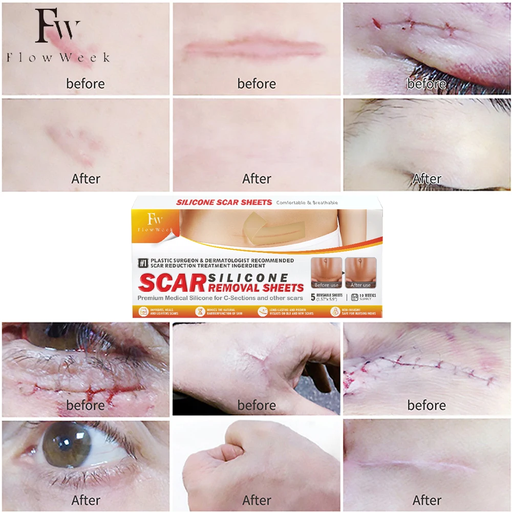 Flow Week Scar Silicone Strips Professional Scar Removal Sheets Effective Scar Removal Strips for C-Section Keloid Surgery Burn