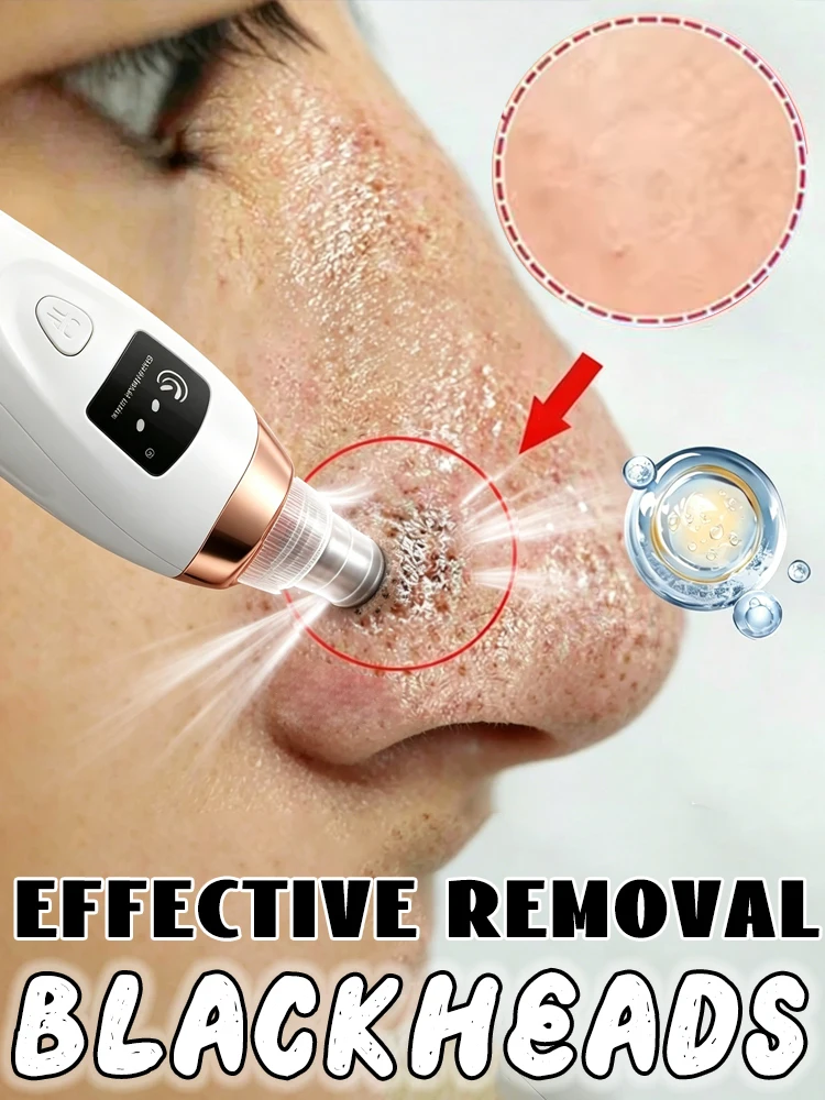 

Blackhead and Blemish Removal Blackhead remover mask-pore vacuum-blackhead remover-nose blackhead remover- In StockFast Shipping