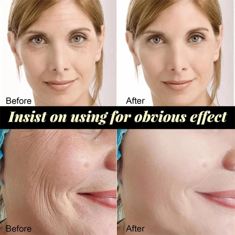 Suero eliminador de arrugas instantáneo, hilo de proteína de colágeno, Lifting, reafirmante, Soluble, relleno facial, antienvejecimiento, cuidado de