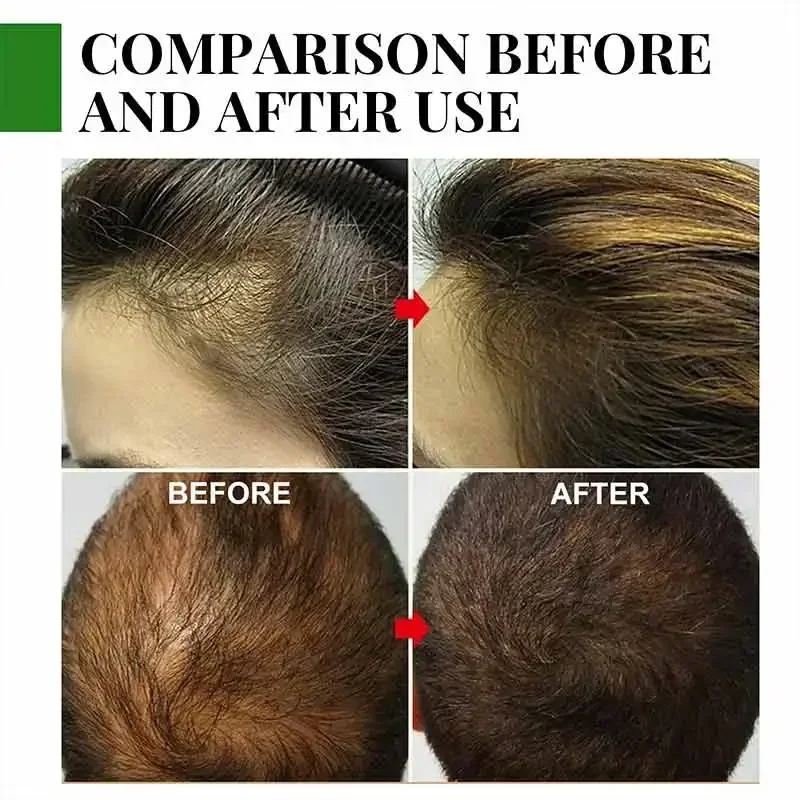 Effective Fast Hair Growth Oil Baldness Repair Hereditary Postpartum Seborrheic Anti Loss