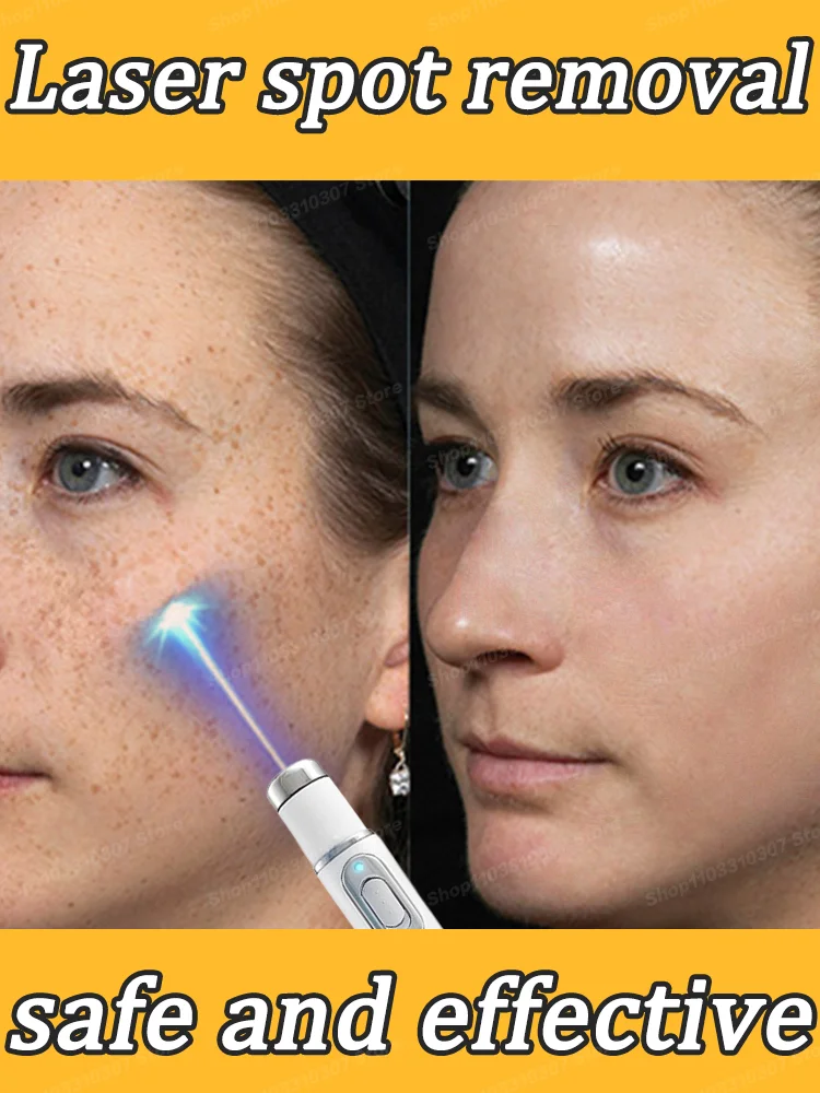 Facial spots disappear Nano laser