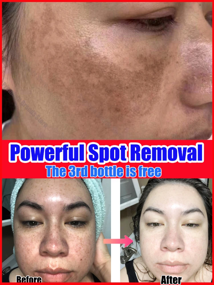 

Spot Removal Cream lighten freckles, chloasma, facial spots, dark spot remover