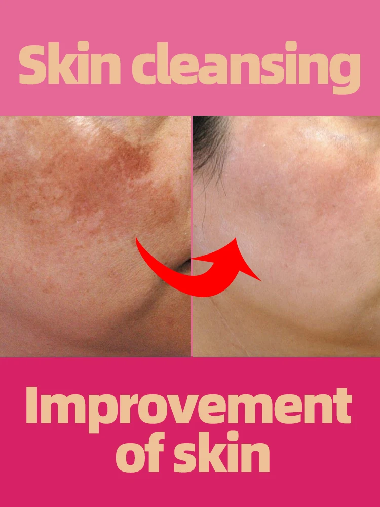 Dark Spot Remover For Face Freckles Melasma