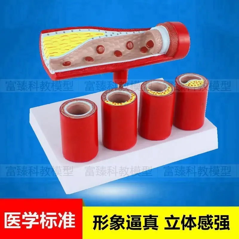 Endometrial Anatomy Of Medical Artery Model To Simulate The Pathological Changes Of Vascular Stenosis With Blood Atherosclerosis