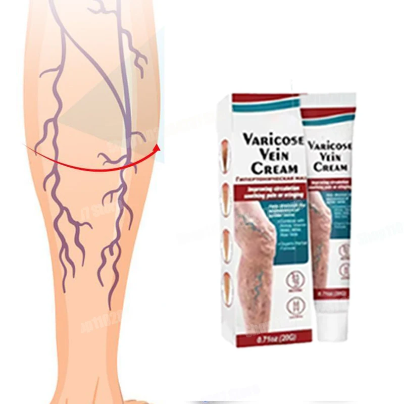 

Varicose Vein Ointment Relieves Spider Legs, Alleviates Vasculitis, Relieves Spider Pain, and Treat Varicose Veins