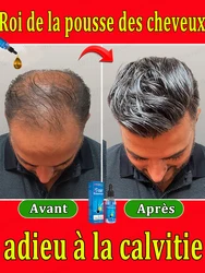 Salvador da perda de cabelo. Repara a linha do cabelo. Diga adeus à calvície e à perda de cabelo