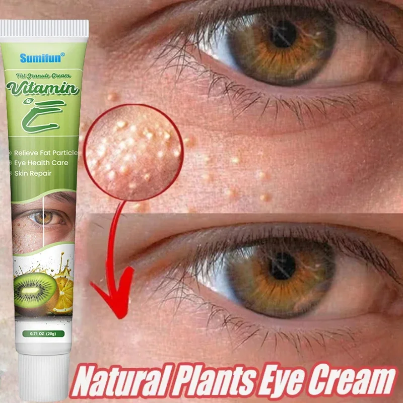 Fat Granules Remover Eye Cream Effective Remove Fat Granules Puffiness Anti-Particles Milia Remover Product Repair Eye Skin Care