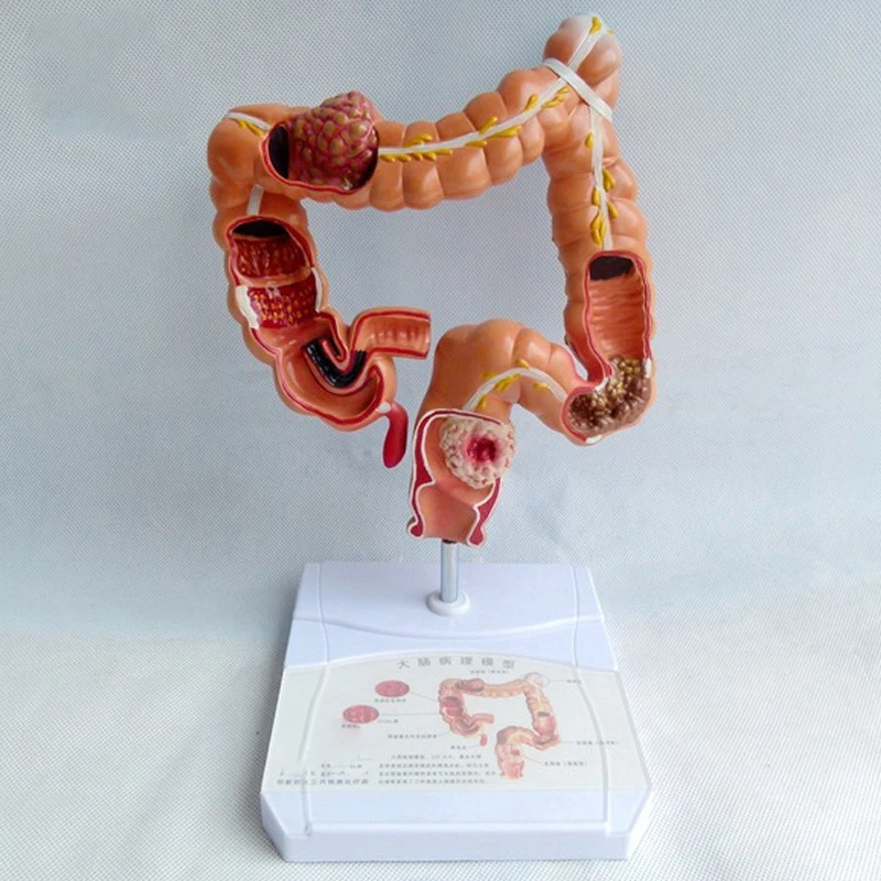 YLC010 Human Colon Pathology Anatomy Model, Medical Teaching Use