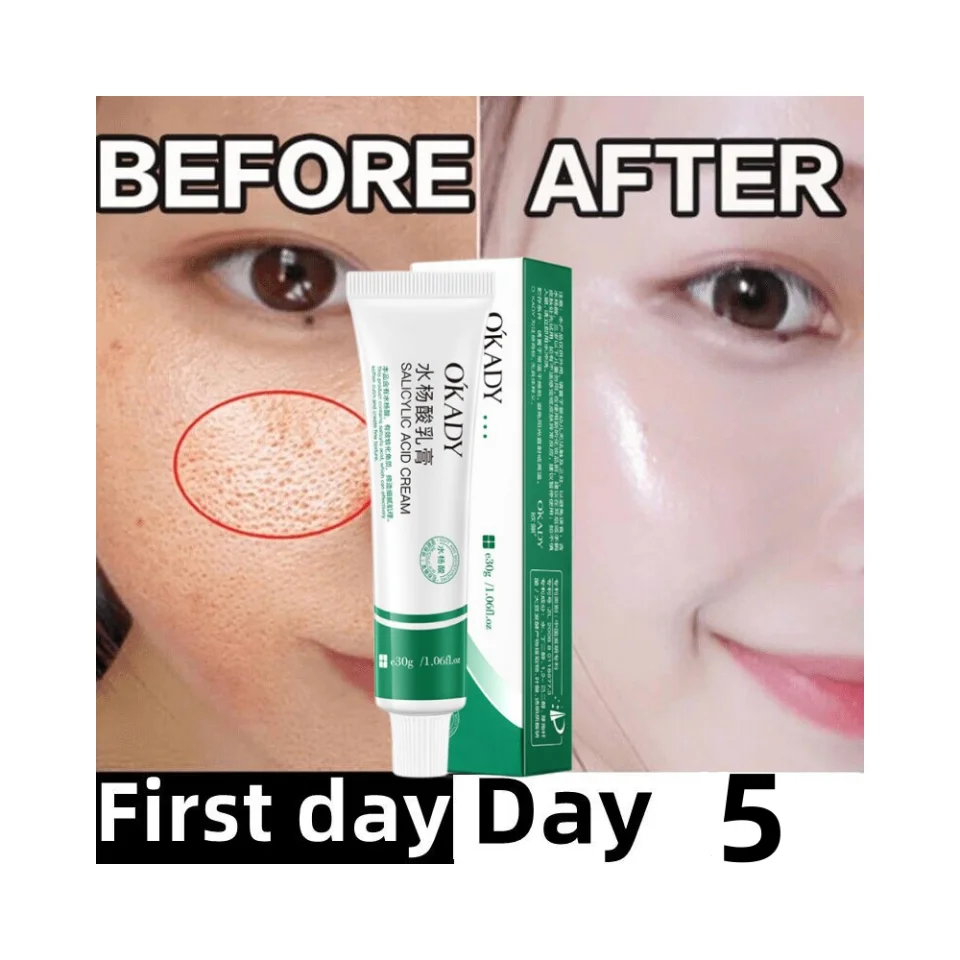 5 Days Powerful Shrink Pores Cream Blackhead Removal Acne Treatment Scar Removal Oil Control Anti-Aging Whitening Moisturize