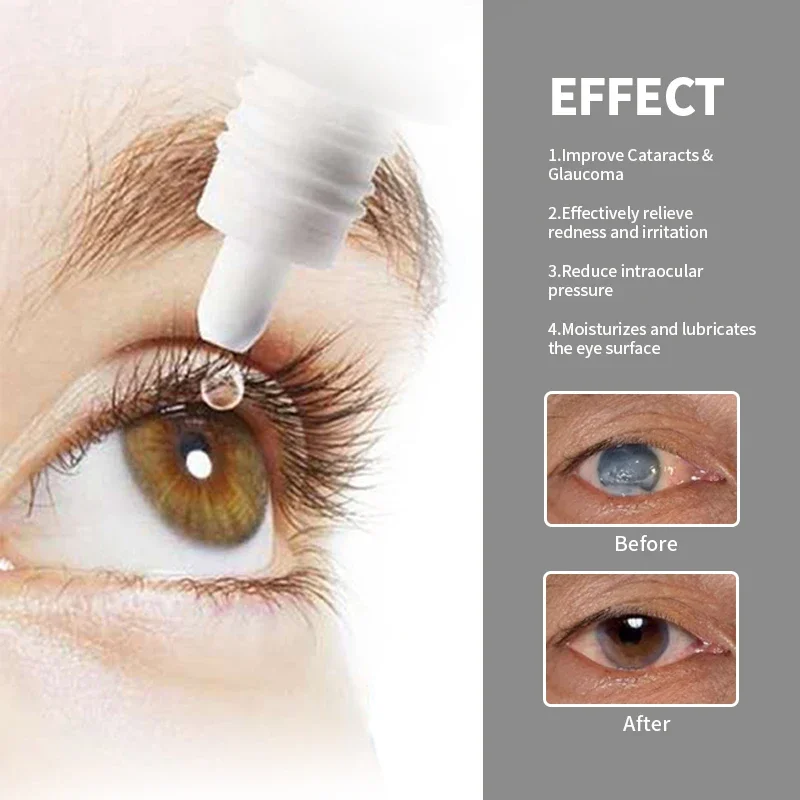 Cataract Treatment Eye Drops Apply To Pain Dry Itchy Eyes Fatigue Removal Blurred Vision Cleaner American Formula Medicine