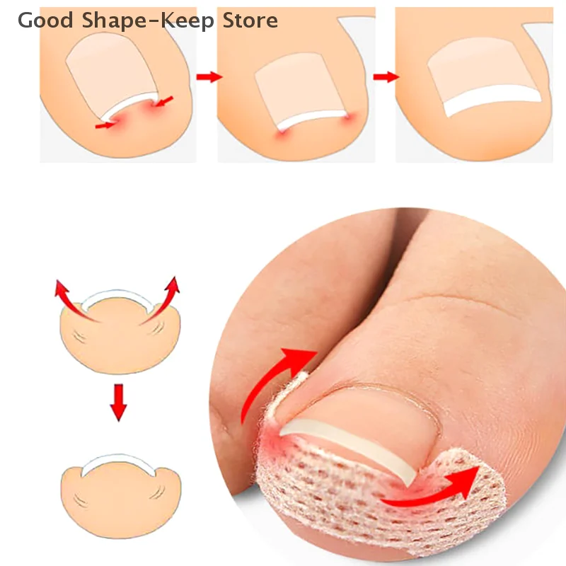 60 قطعة شرائط مصحح أظافر نام مكافحة مسمار التصحيح وسادة تو طويلة لداحس العناية بالقدم النوم مسمار التصحيح الأظافر في اللحم