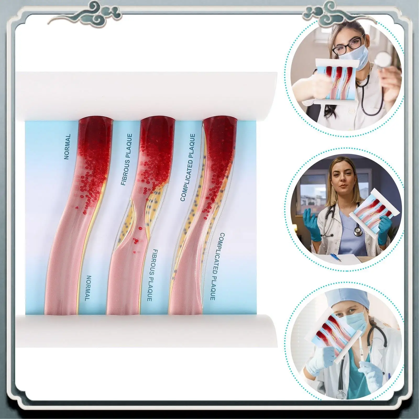 

Premium Dynamic Blood Vessel Model Cardiovascular Blockage Contrast Model Thrombosis Model For Teaching Explanation