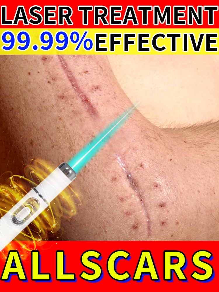 

Hot Selling Laser Scar Repair Keloids.