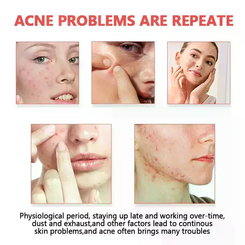 Invisible Pimple Cover For Face Oil Control Spot Treatment Cute Sticker For Covering Zits And Blemishes Patches