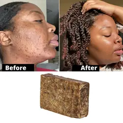 Original African Black Soap, Dark Spots Remover, Acne Remover, Clear Skin 100g