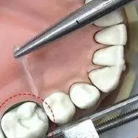 

Stainless Steel Dental Tofflemire Matrix Retainer Senior Molding Clip for Dentist - Dental Lab Instrument & Orthodontic Tool