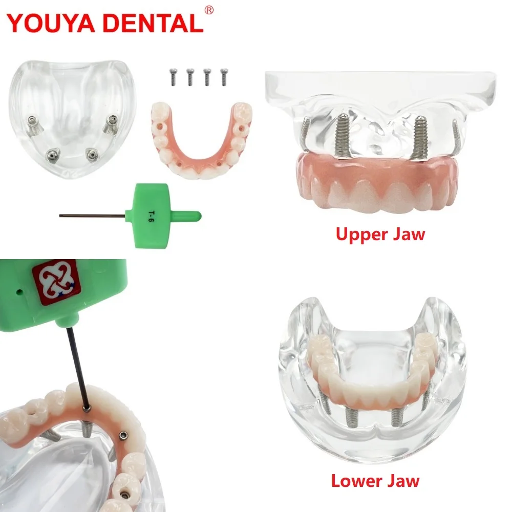 

Upper/Lower Jaw Dental Implant Model All On 4 Dental Overdenture Teeth Model With Removable Recondition Implants For Education