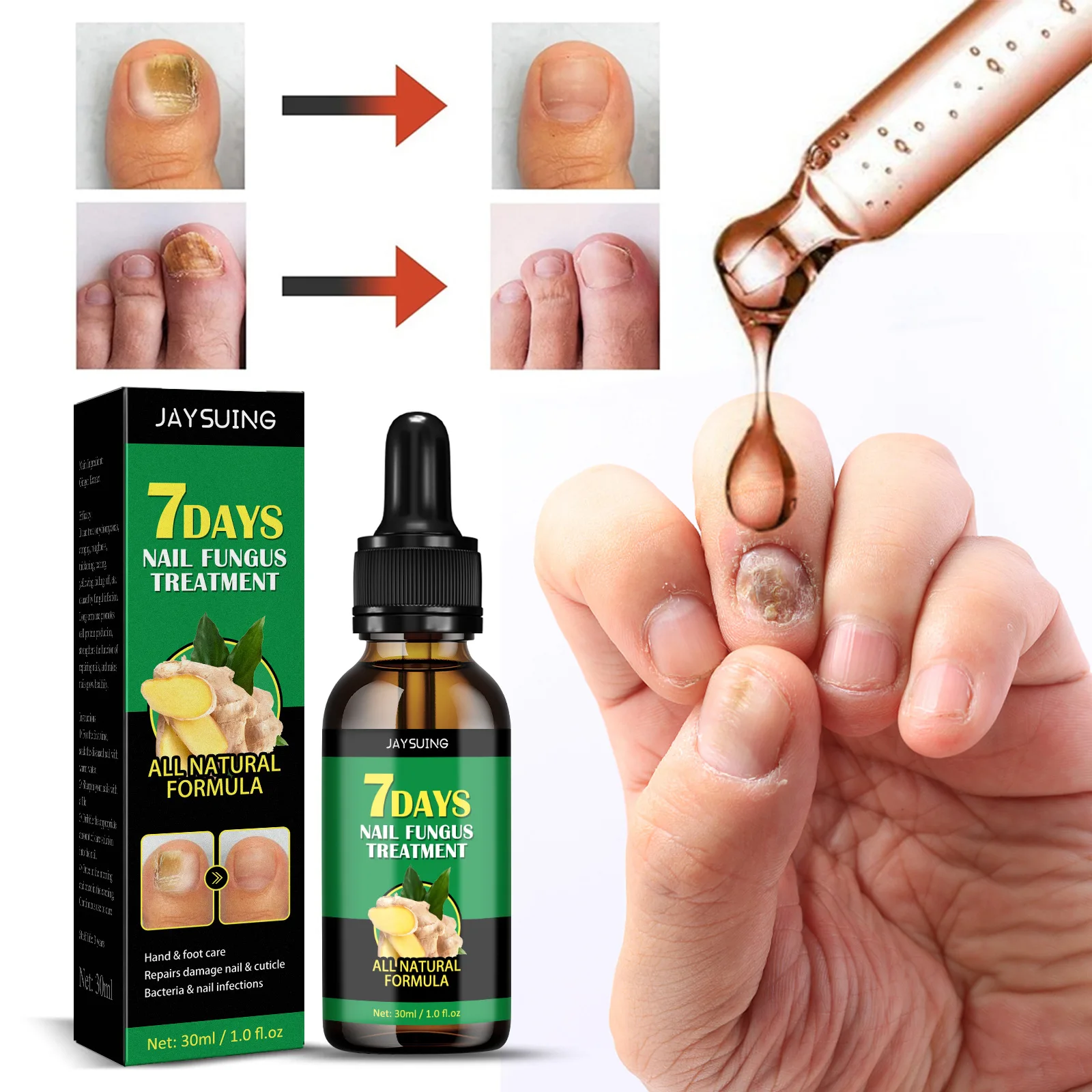 Liquid Fungal Nail Treatment Essence Oil Nail Fungus Laser Device Repair Toenail Fingernail Ginger Treatment Hand Foot Essence