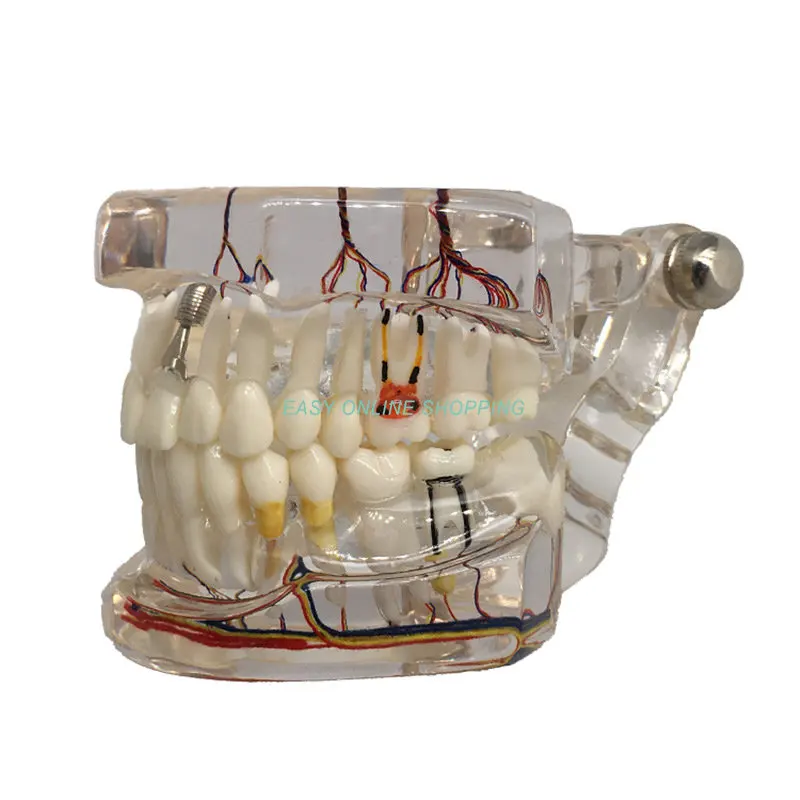 

New Dental Teaching Teeth Model with Nerve Implanted Transparent Pathological Repair Teaching Demonstration model