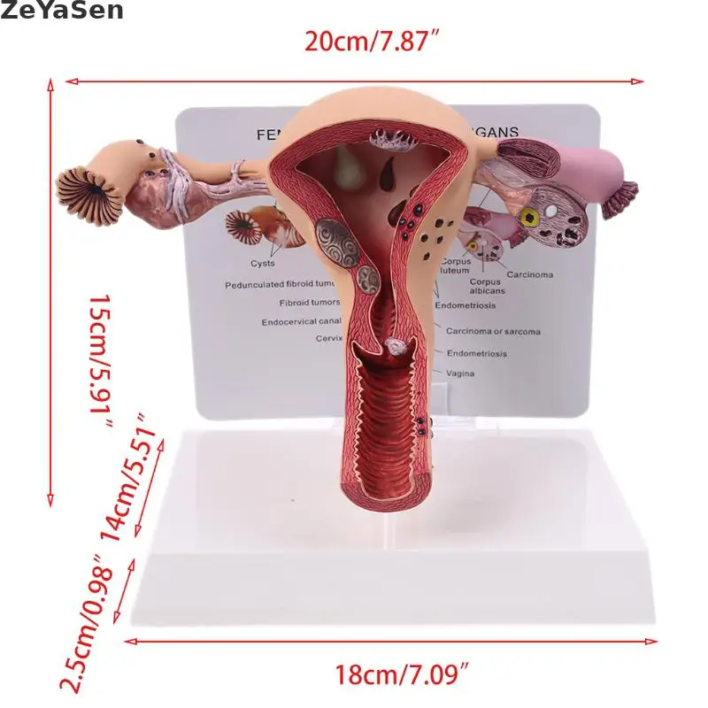 Medical props model Human Female Pathological Uterus Ovary Model Anatomical Disease Pathology Medical Lesion ForBiology Teaching