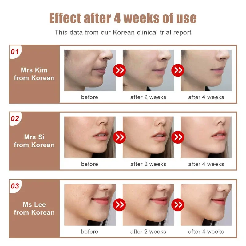 Máquina plástica facial de microcorrente ems, terapia de fótons led, vibração, massagem facial, queixo duplo, linha v, máquina plástica facial