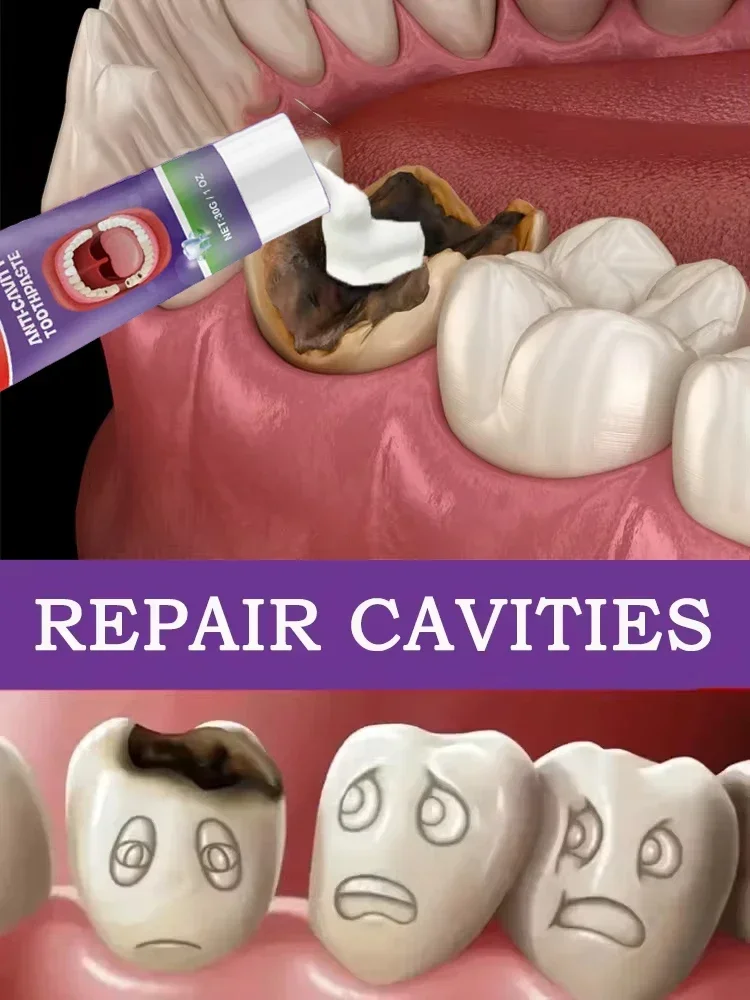 Anti Caries Repairing Cavities Tooth Decay Repair