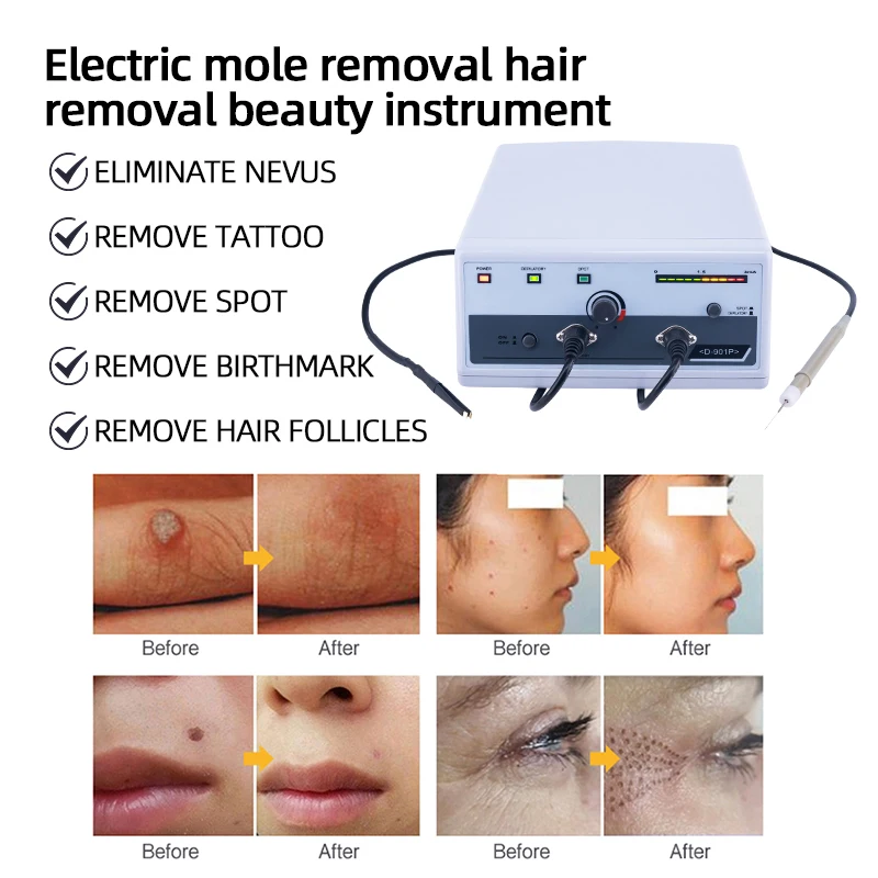 آلة إزالة الشعر الاحترافية المحمولة في صالونات التجميل لبقع الثآليل