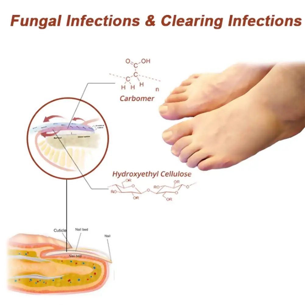 1pcs เชื้อราเล็บอุปกรณ์เลเซอร์เล็บ Fungal Treatment Essential Oil Repair เล็บเท้าเล็บ Anti Infection Onychomycosis Cure