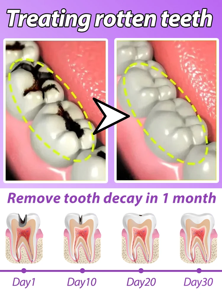 Tratamientos anticaries para caries y caries.