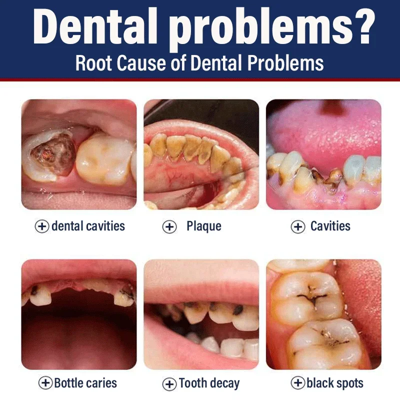 Blanchiment des dents efficace pour éliminer les cavités, plaque de calcul, parodontite