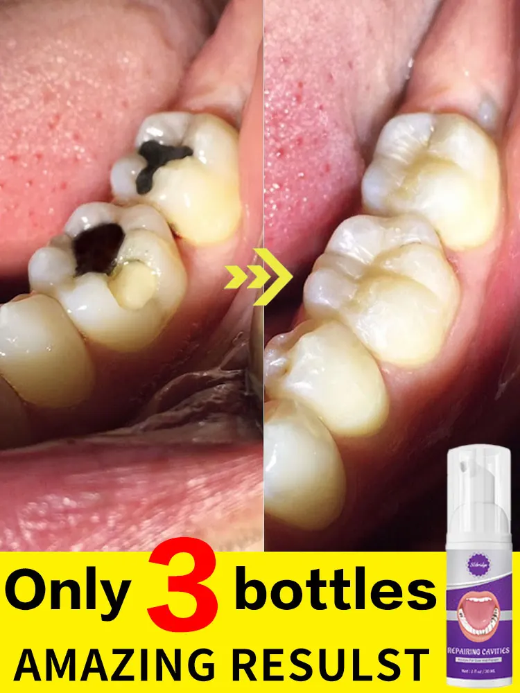 Hot selling Tooth Repair mousse to repair tooth decay