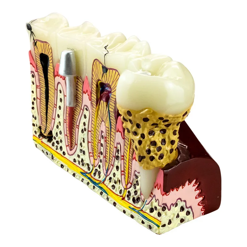 Tandheelkundige Implante Modelherstel Pathologisch Tandmodel Tandheelkundig Anatomisch Model Voor Tandheelkundig Onderwijs Training Tandarts Leren
