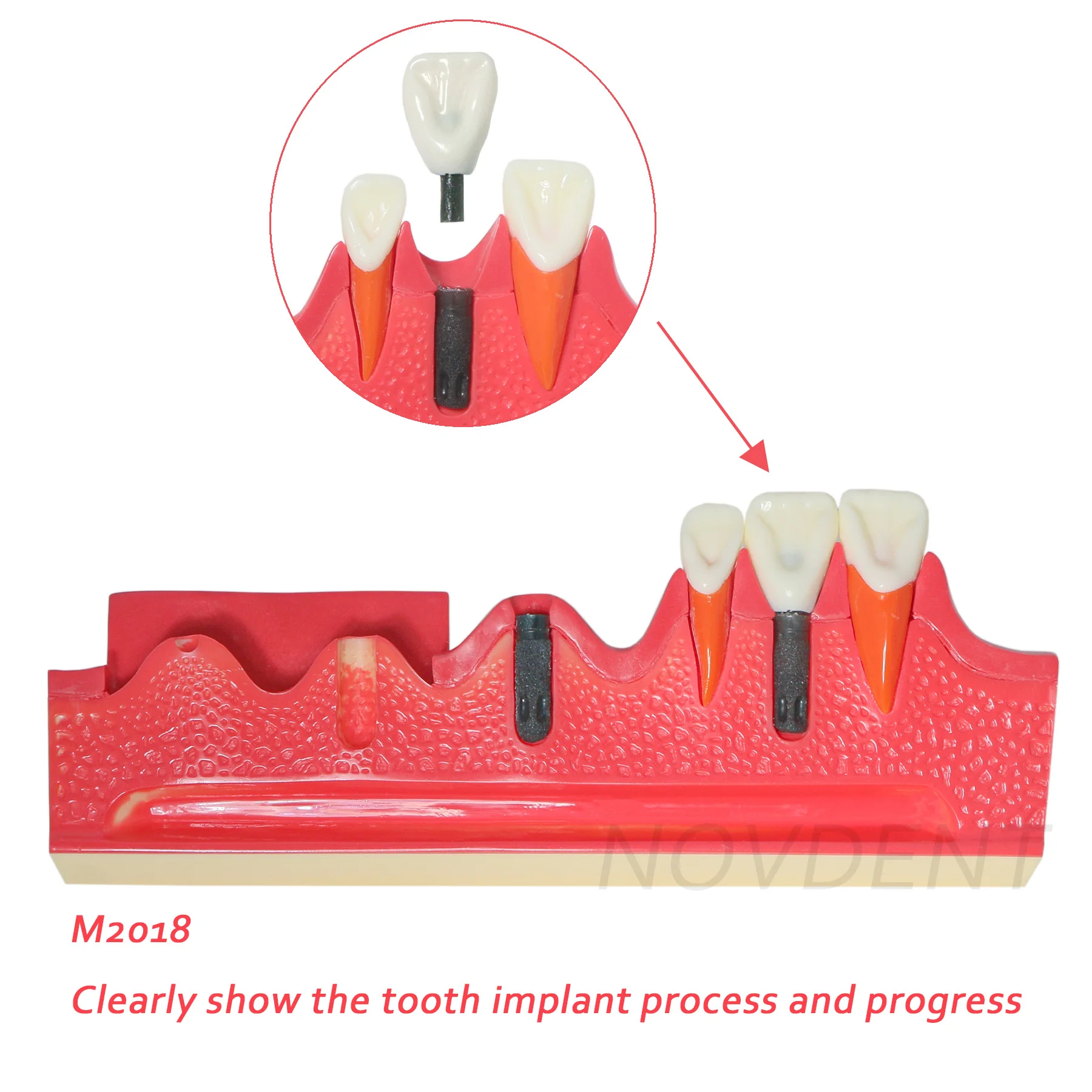 

Dental Implant Model Tooth Show the Tooth Implant Process and Progress M2018