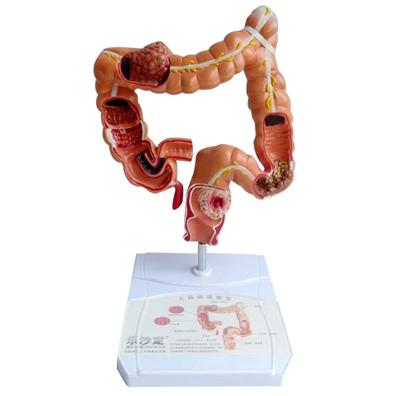 

Teaching Model,Human Large Intestine Anatomy Model Visceral Lesion Model Human Digestive System Learning Model Easy Install