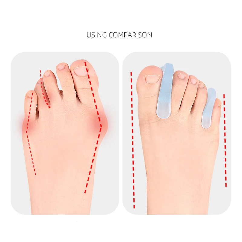 

4Pcs=2Pairs Soft Transparent A-shaped Toe Separator Thumb Bunion Overlapping Toe Correcttor Pain Relief Silicone Foot Care Tool