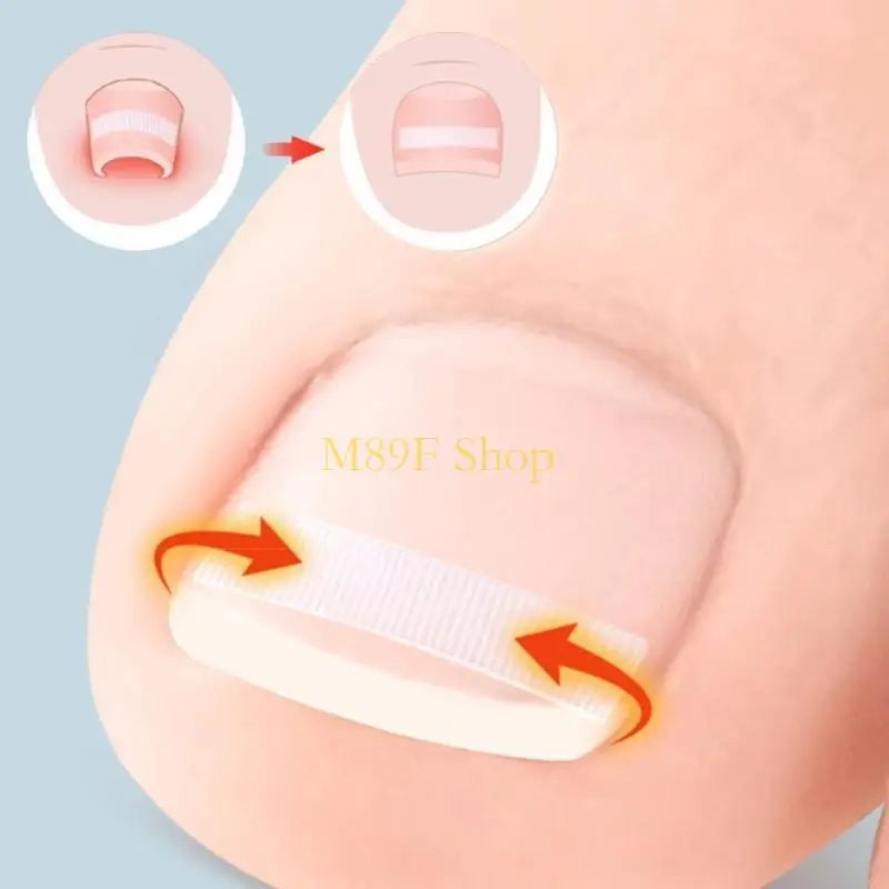 M89F 5PCS ingegroeide teennagelcorrector strips ingegroeide teennagelbehandelingen Tool voetzorg