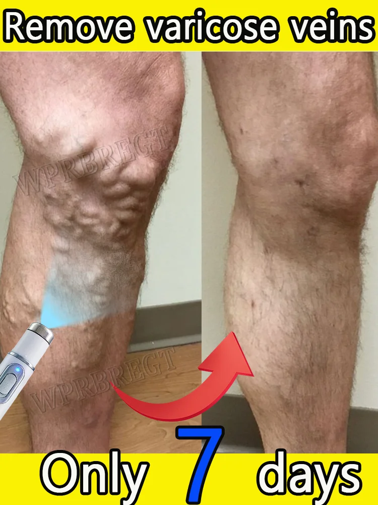 

Нанотехнологический лазер быстро удаляет варикозное расширение вен, ноги-паука и другие условия.