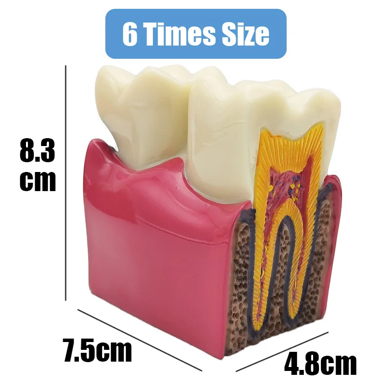 8 Times Dental Caries Model Disease Teeth Dental Model for Dental Demonstration Model Dentist Teaching Dental Lab Oral Research