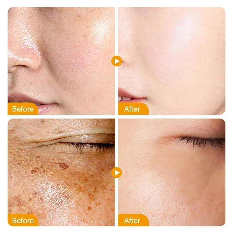Vitamin C Whitening Freckles Facial Serum Remove Dark Spots Melasma Niacinamide Lighten Melanin Acne Scars Anti-aging Skin Care