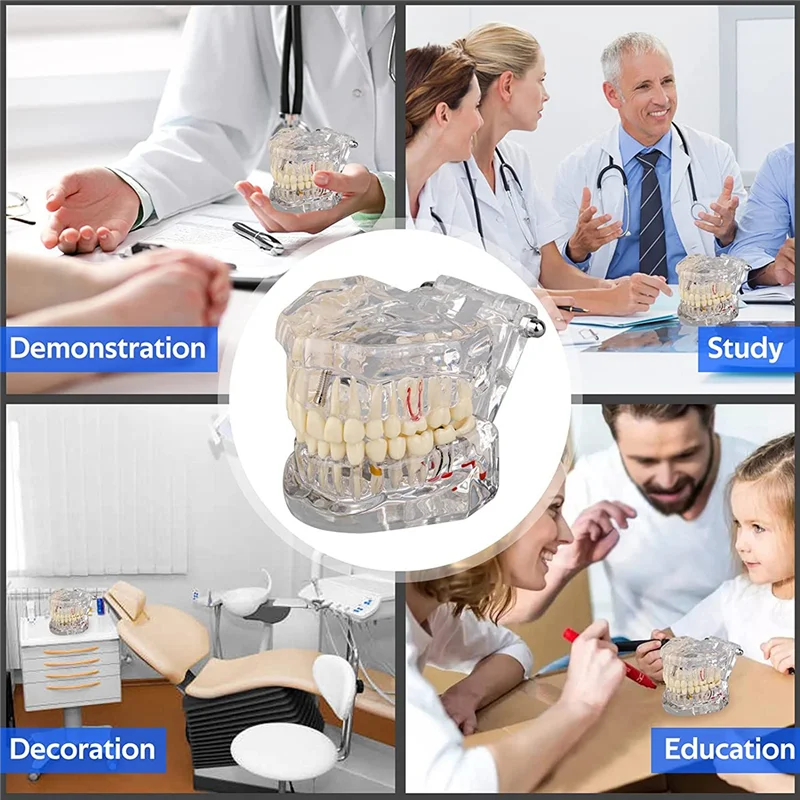Modello di denti per malattie trasparenti con ponte per impianto dentale, modello dentale per l'educazione del paziente e degli studenti odontotecnici