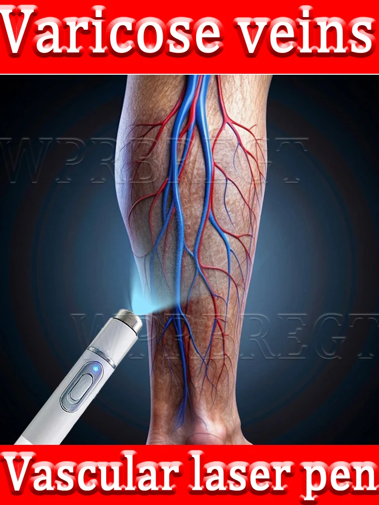 

New vein laser pointer: 2nd generation