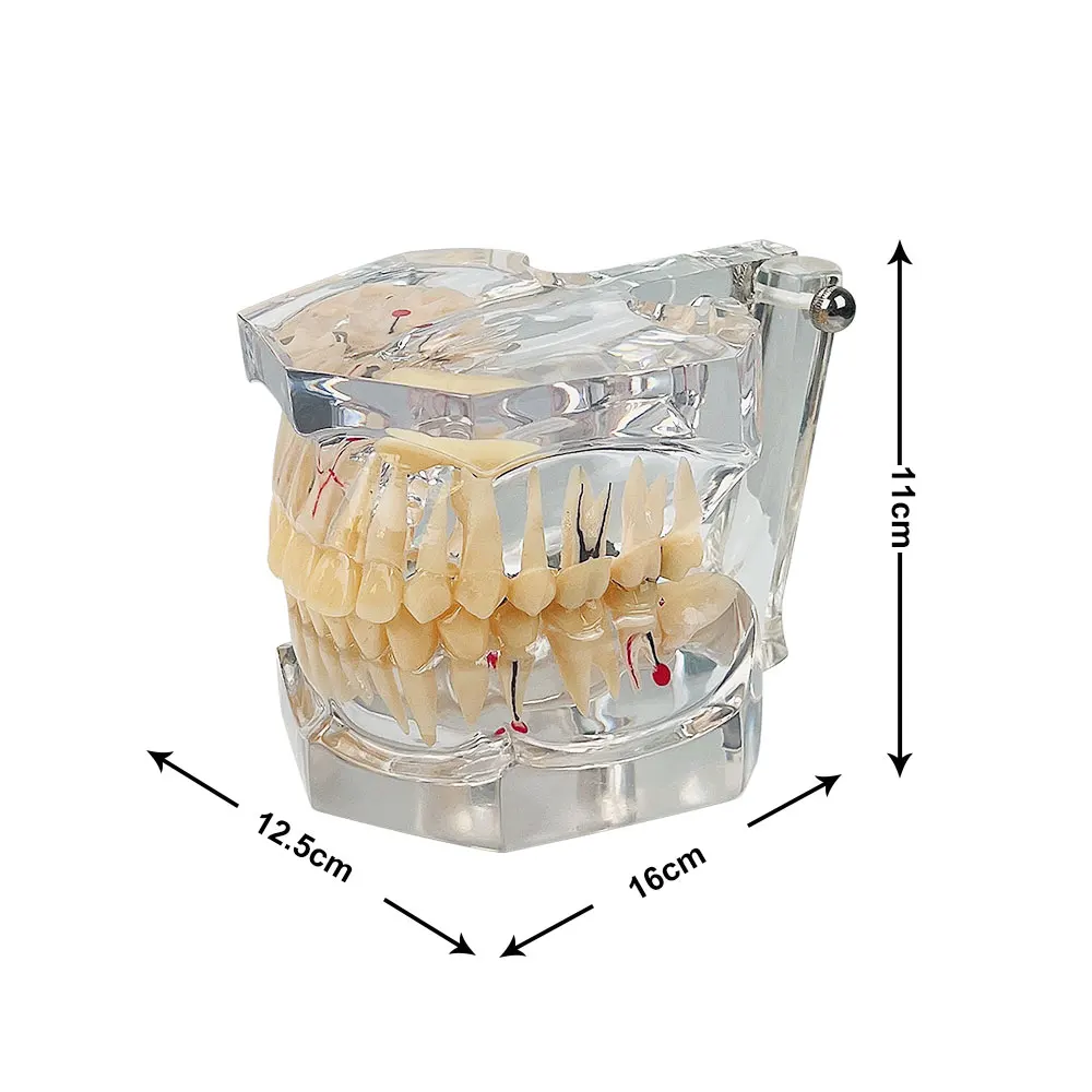 Dental Pathology Teeth Model 2.5 Times Dentistry Teach Implant Model Dentist Student Training Education Demonstration Tools