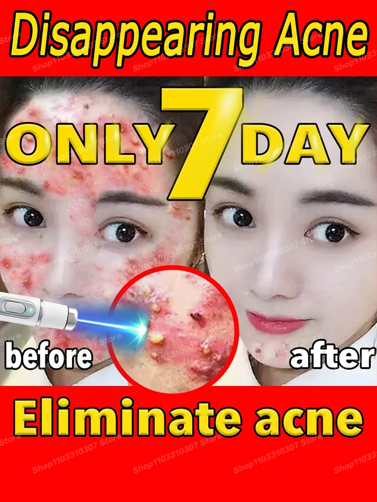 

Acne Cream Remedy Anti Pimple Marks Serum