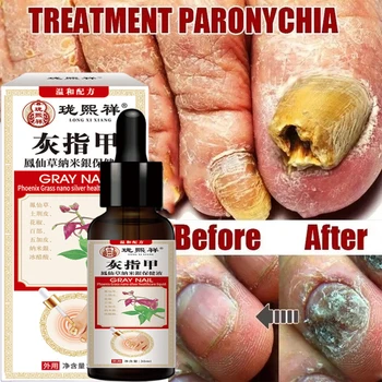 Nail Fungus Treatment Serum Foot Repair Liquid Toe Nails Fungal Removal Gel Anti Infection Paronychia Onychomycosis Cream 30ml 1
